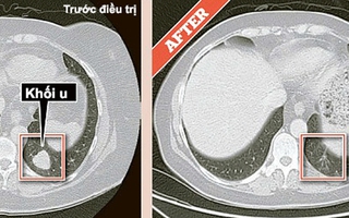 "Bước đột phá vĩ đại" trong cuộc chiến chống ung thư